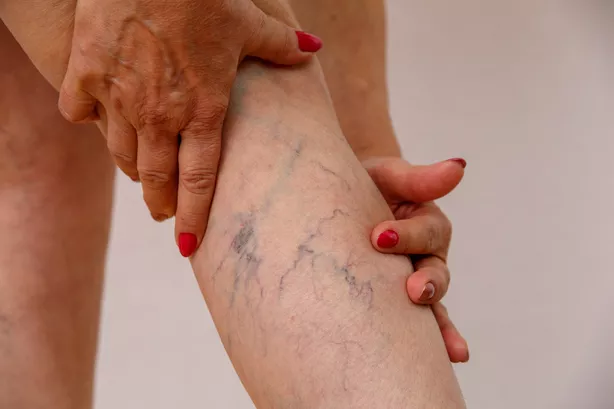 Woman Showing Varicose Veins on her legs
