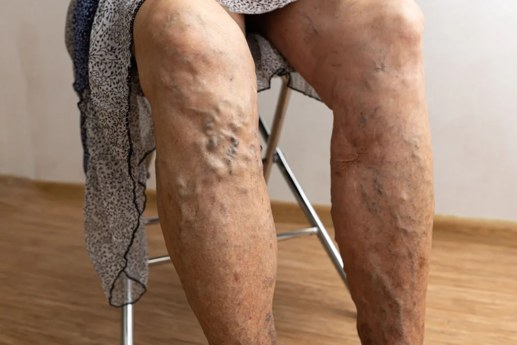 Chronic Venous Insufficiency