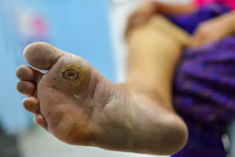 Sore in feet is a symptom of Peripheral Artery Disease