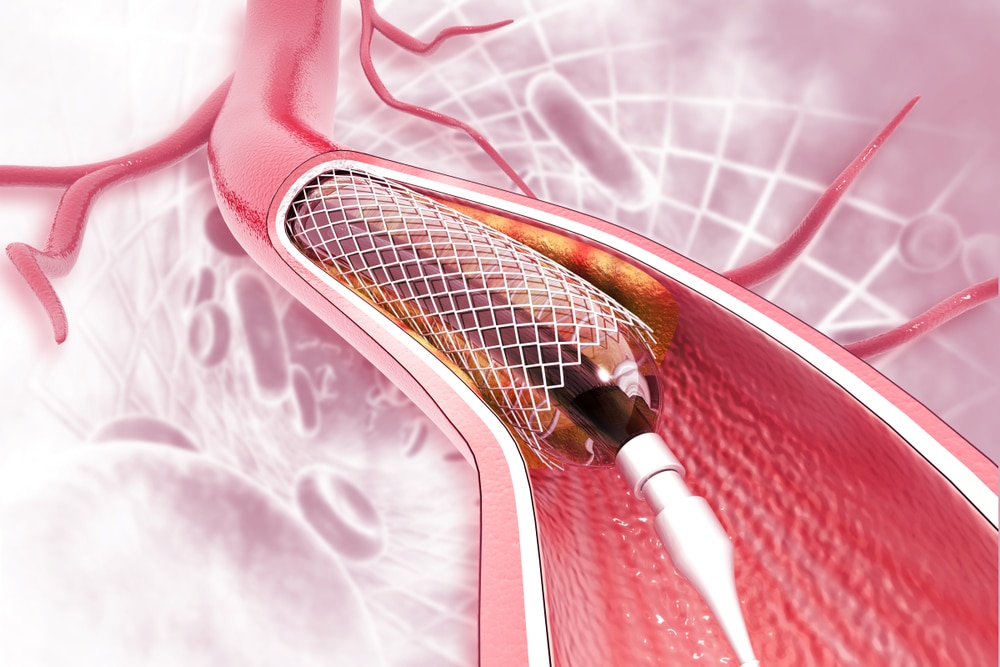 Stent,Angioplasty,On,Scientific,Background.,3d,Illustration